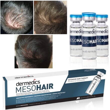  Kurz Mezoterapie Vlasov vrátane príslušenstva